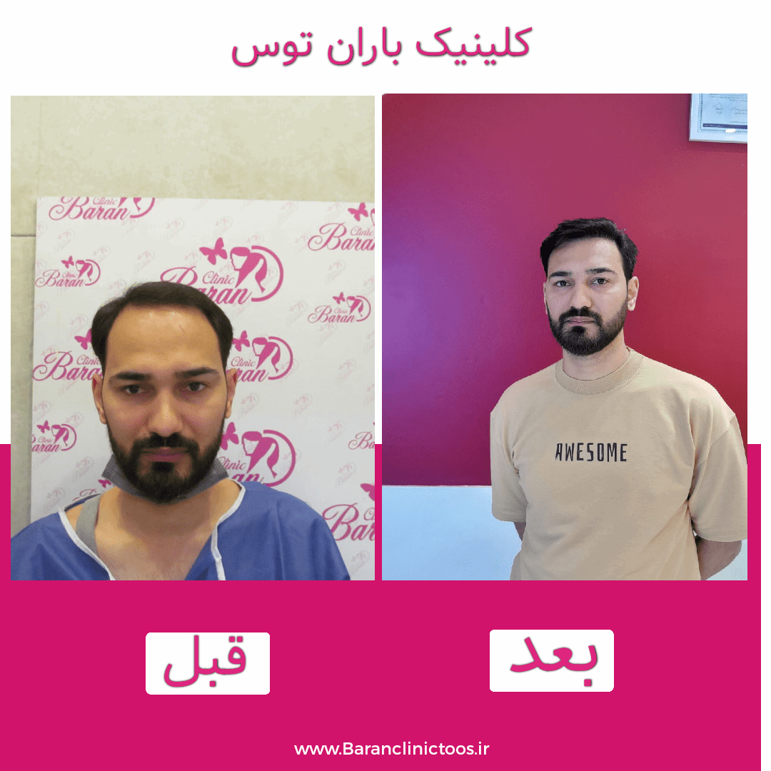 قبل و بعد کاشت مو